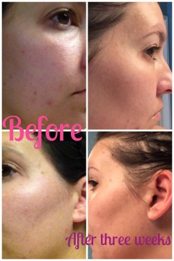 Rodan + Fields: My personal before and after using Unblemish, 2014 Copyright Christine Hull, Windy Pinwheel